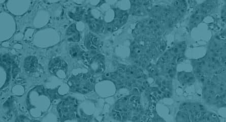 Minimal residual disease: What is it and why is it important?