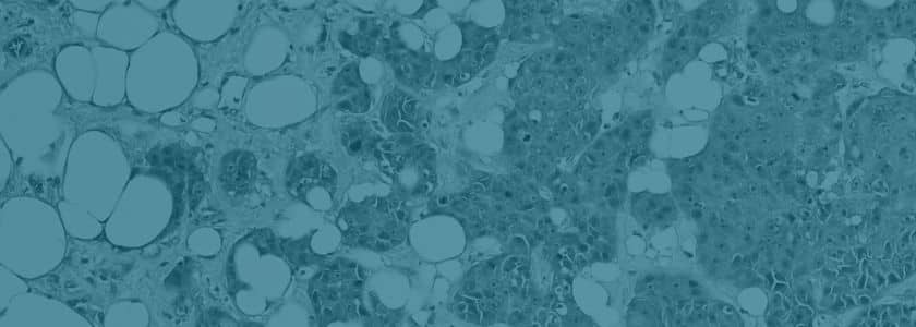 Minimal residual disease: What is it and why is it important?